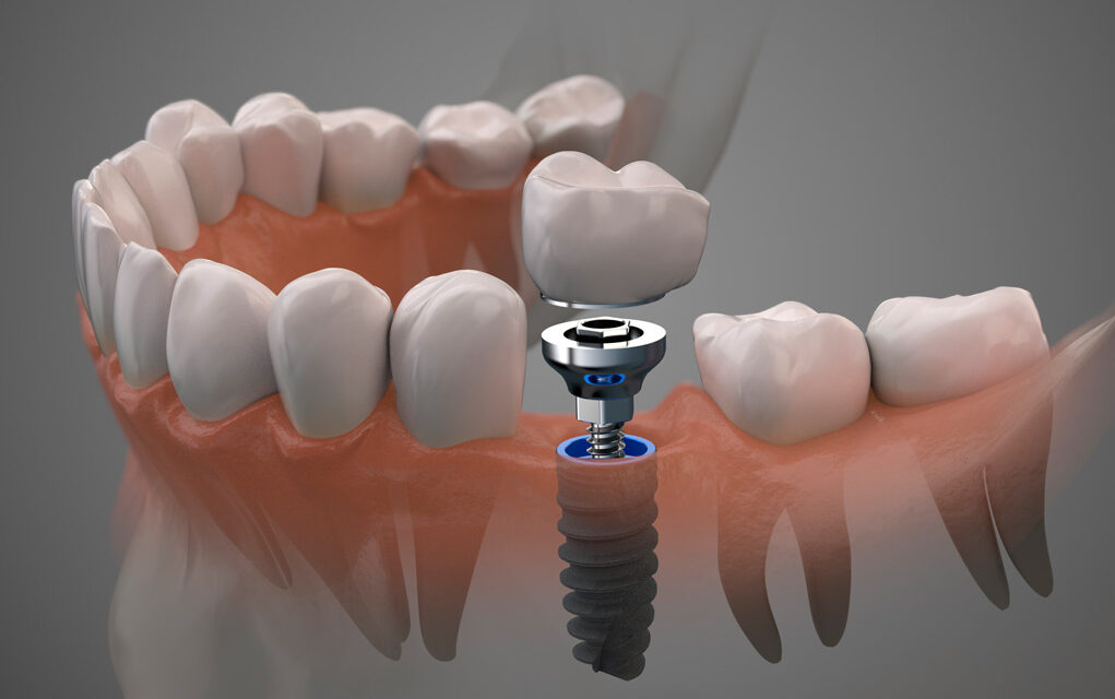 Implantes dentales