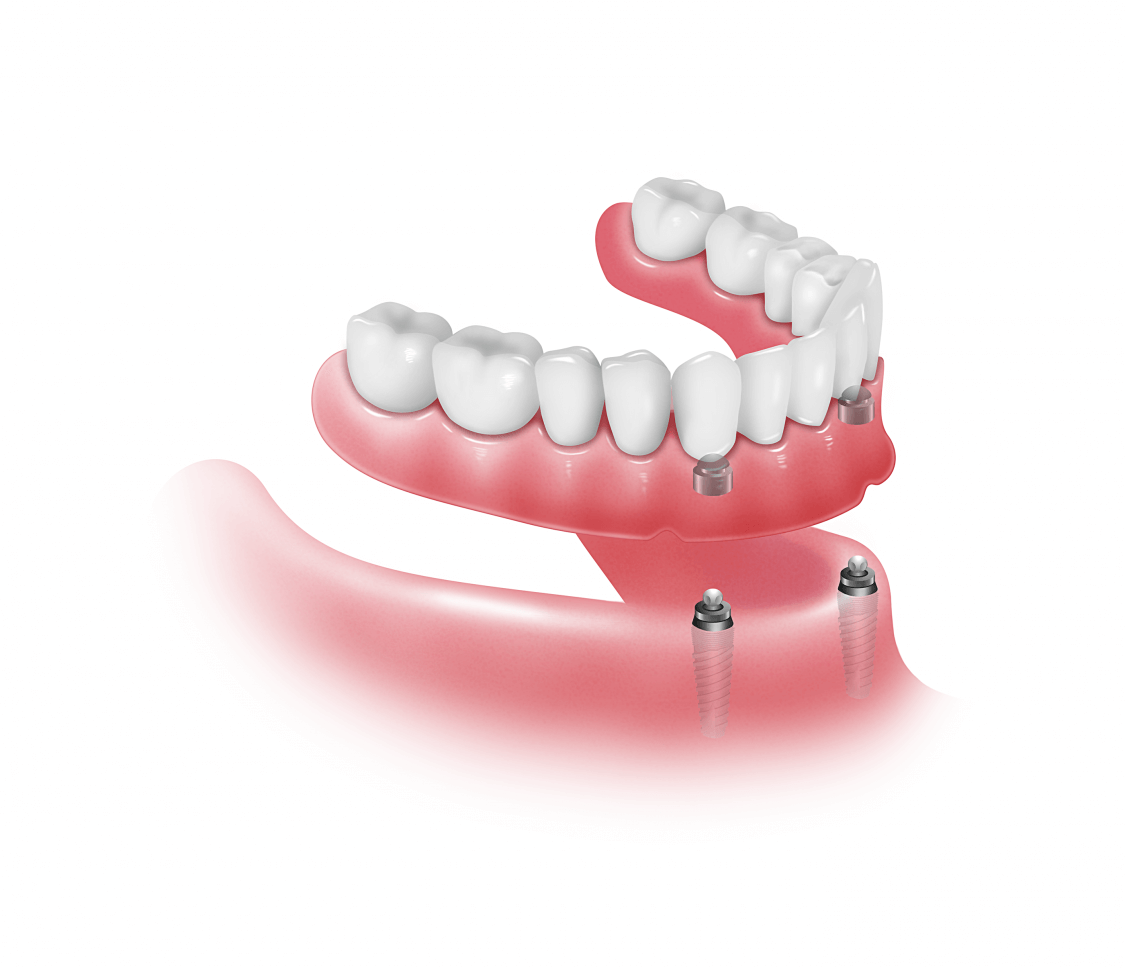 Prótesis sobre implantes