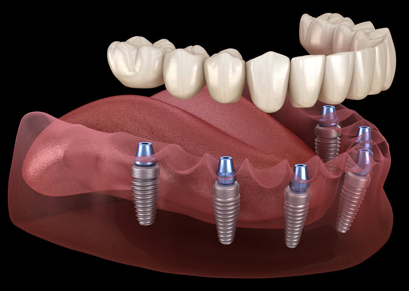 Implantes de carga inmediata