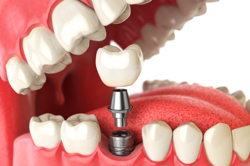 Especialistas en implantes dentales