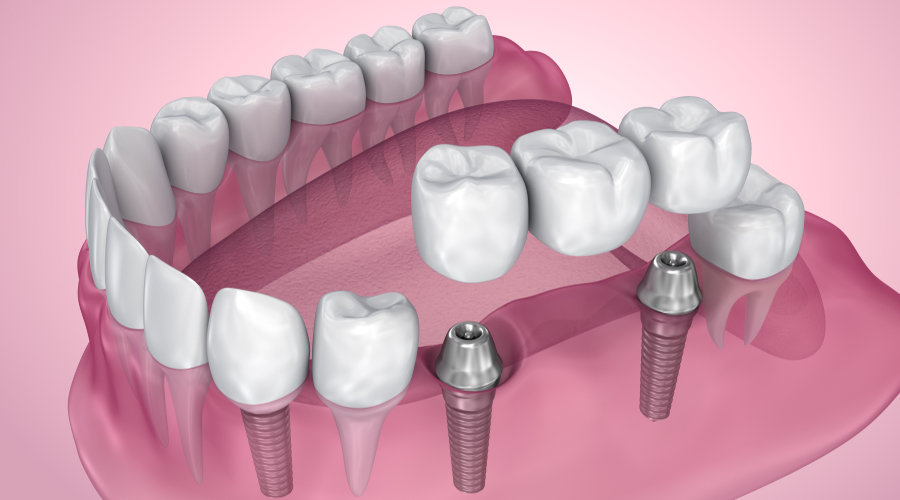 Implantes de titanio