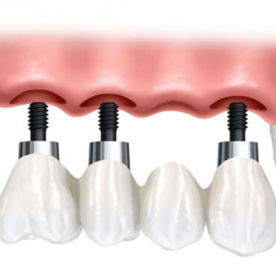 PUENTE SOBRE 3 IMPLANTES