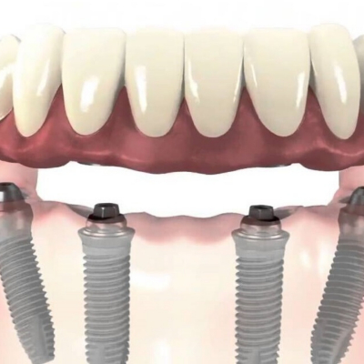 PRÓTESIS SOBRE 4 IMPLANTES